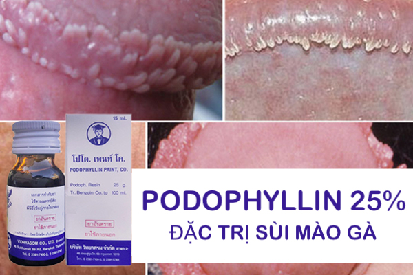 Cung cấp Thuốc Podophyllin 25 Thái Lan chữa trị sùi mào gà tại nhà cho nam nữ hàng xách tay